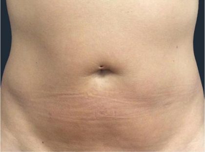 TruSculpt ID Before & After Patient #1566
